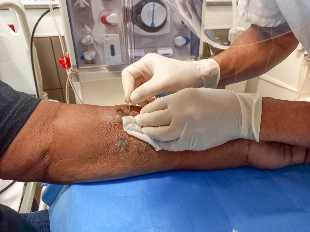La technique du buttonhole permet au patient de se ponctionner lui-même sans douleur, diminue le taux d’échec des ponctions et préserve la fistule artério-veineuse